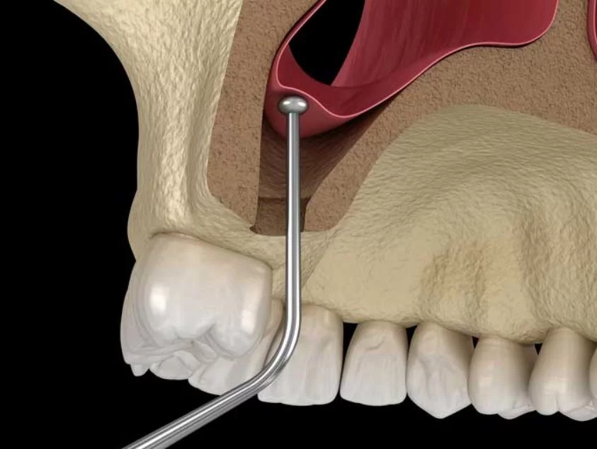 MANEJO DEL SENO MAXILAR - MAXILOFACIAL EN BOGOTÁ