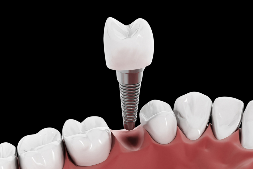 Materials Used: Titanium vs. Zirconia