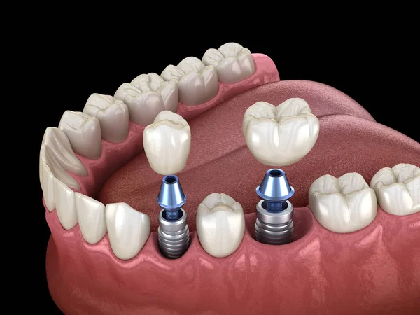 IMPLANTES DENTALES - CIRUGÍA MAXILOFACIAL EN BOGOTÁ