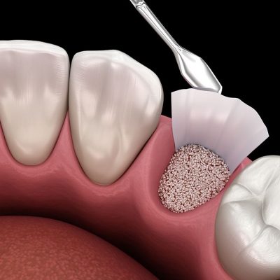 INJERTOS OSEOS - CIRUGÍA MAXILOFACIAL EN BOGOTÁ