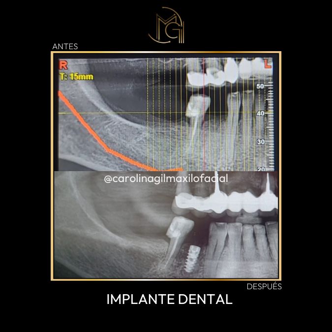 ANTES Y DESPUÉS CIRUGÍA MAXILOFACIAL EN BOGOTÁ