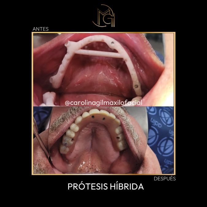 ANTES Y DESPUÉS CIRUGÍA MAXILOFACIAL EN BOGOTÁ