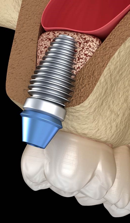 Elevación del Seno Maxilar - Cirujana Maxilofacial en Bogotá