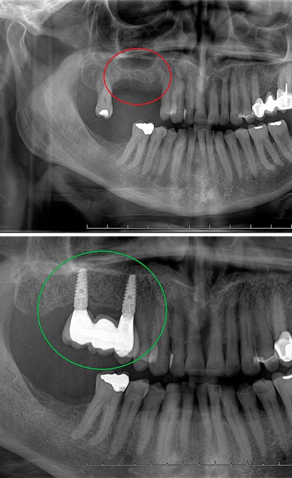 Elevación del Seno Maxilar - Cirujana Maxilofacial en Bogotá