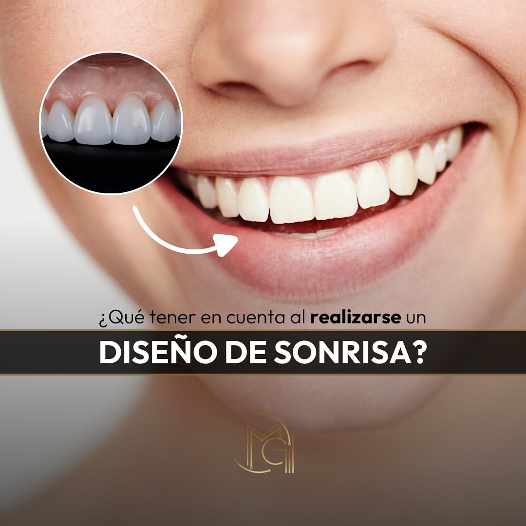 Diseño de Sonrisa Bogotá - Dr. Carolina Gil - Cirujana Maxilofacial