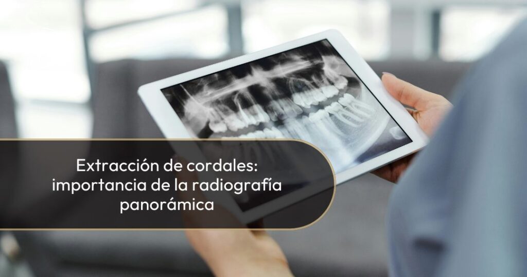 Importancia de la radiografía panorámica para la extracción de cordales - Dra. Carolina Gil Cirujana Maxilofacial