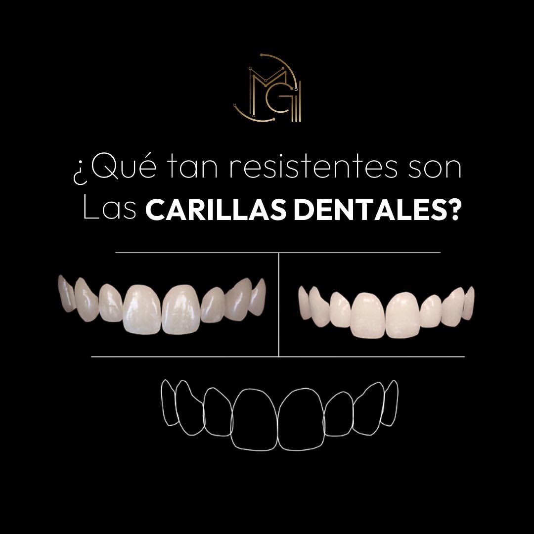 Carillas Dentales en Bogotá - Dr. Carolina Gil - Cirujana Maxilofacial en Bogotá