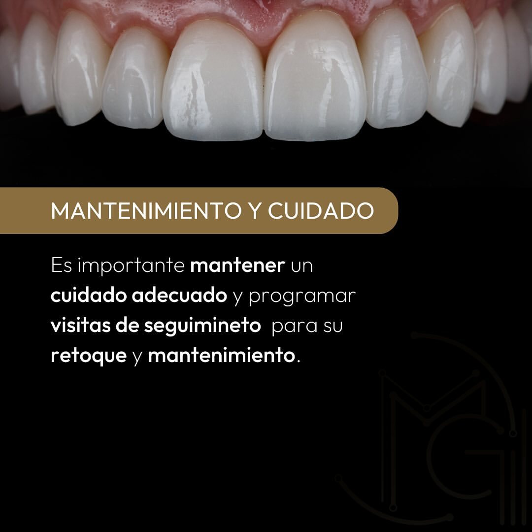 Carillas Dentales en Bogotá - Dr. Carolina Gil - Cirujana Maxilofacial en Bogotá