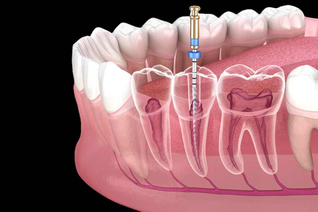 Tratamiento de Conductos - Dra. Carolina Gil Cirujana Maxilofacial en Bogotá