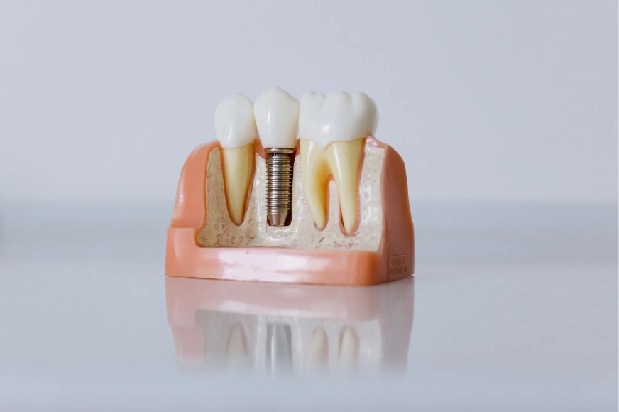 Implantes Dentales