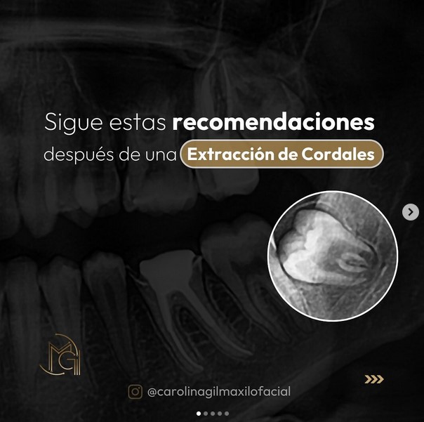 Extracción muelas del juicio panamá precio