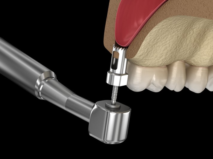 Elevación de seno maxilar-Dra. Carolina Gil