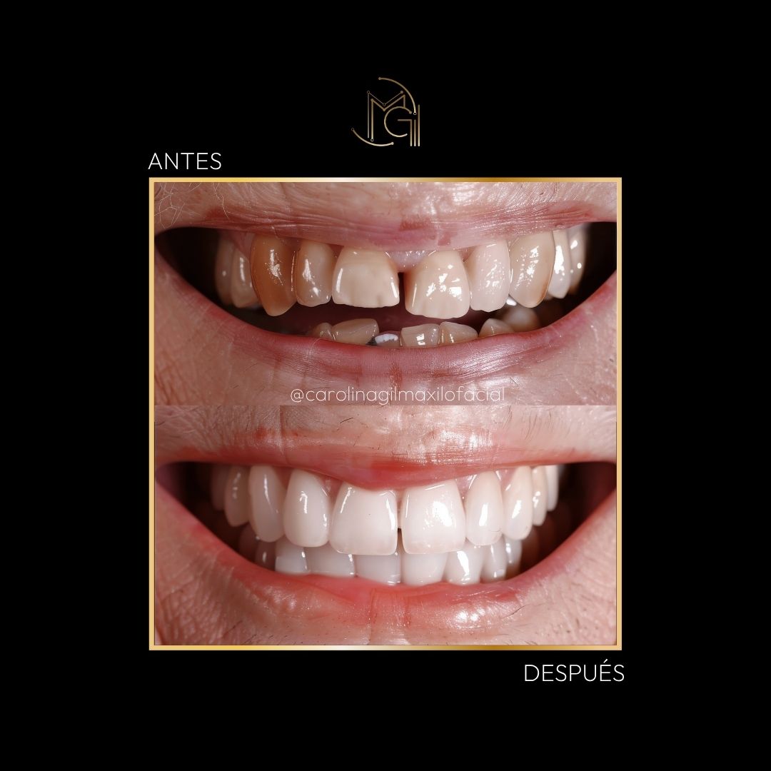 Carillas dentales y limpieza dental antes y después - Dra. Carolina Gil - Imagen de referencia - Bogotá, Colombia