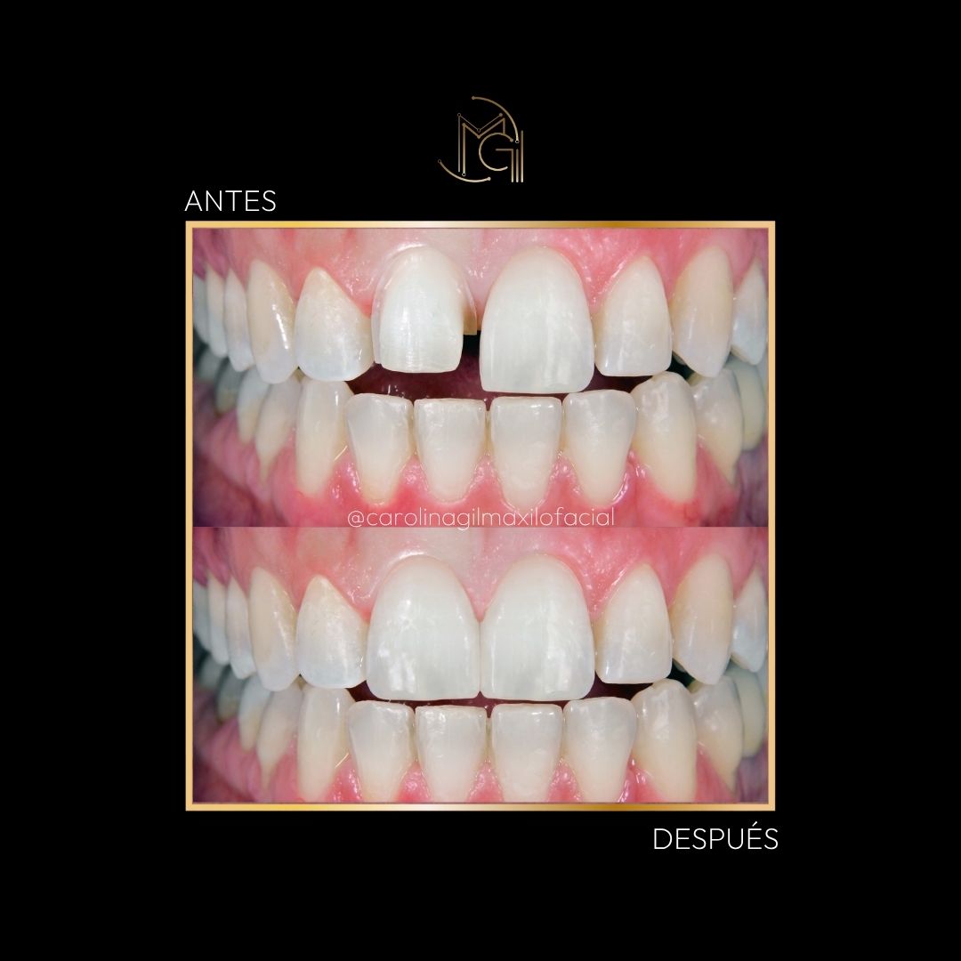 Diseño de sonrisa antes y después - Dra. Carolina Gil - Imagen de referencia