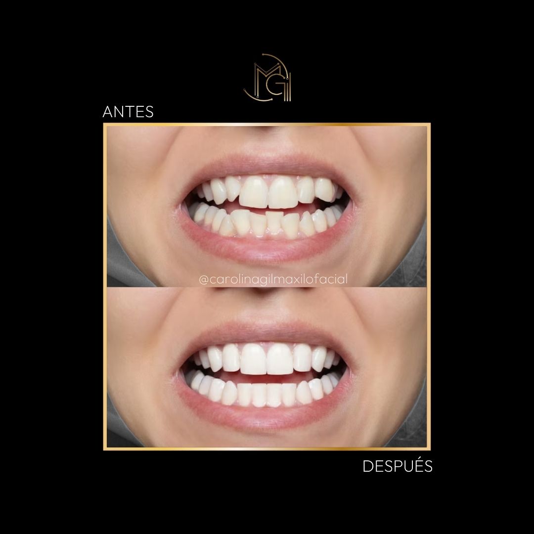 Diseño de sonrisa y carillas dentales antes y después - Dra. Carolina Gil - Imagen de referencia - Bogotá, Colombia