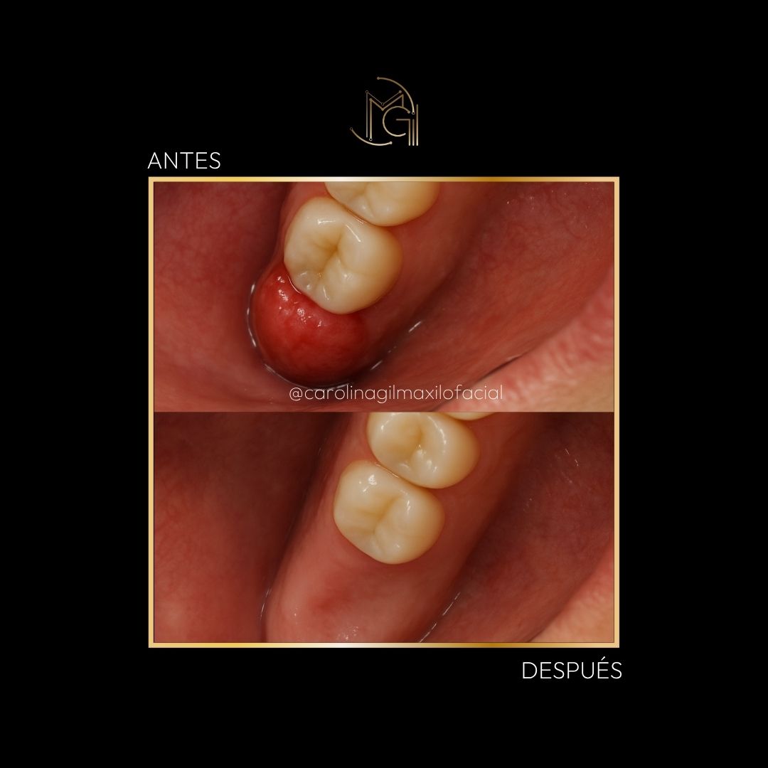 Extracción de cordales antes y después - Dra. Carolina Gil - Imagen de referencia - Bogotá, Colombia