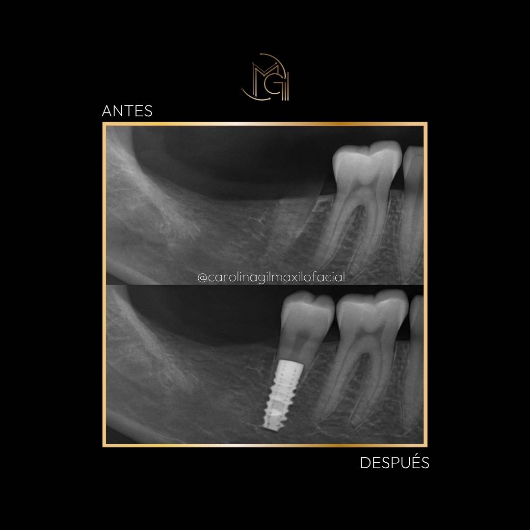 Implante dental antes y después - Dra. Carolina Gil - Imagen de referencia - Bogotá, Colombia