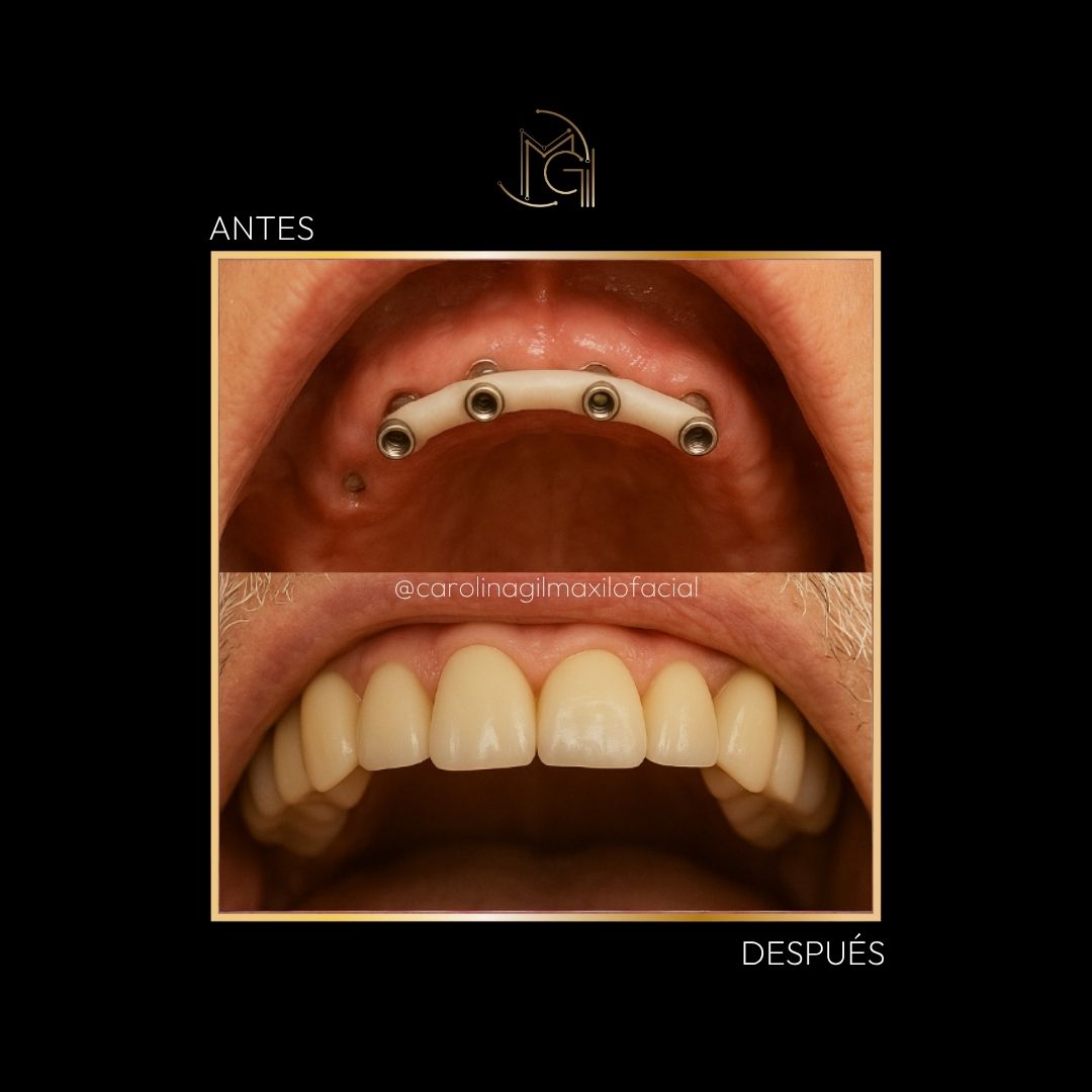 Prótesis híbrida antes y después - Dra. Carolina Gil - Imagen de referencia - Bogotá, Colombia