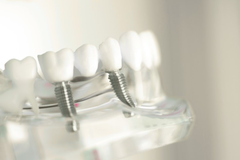 Cost of mouth dental implants in Colombia - Dr. Carolina Gil