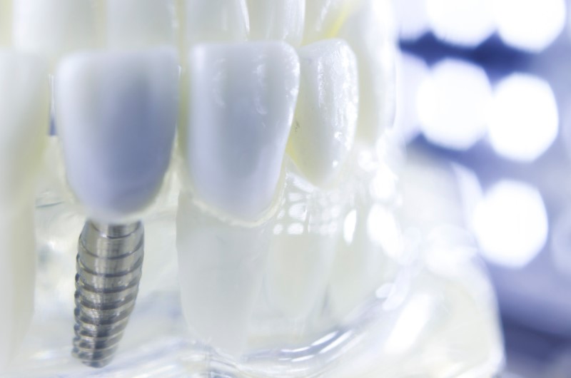 Implantes de titanio-Dra. Carolina Gil