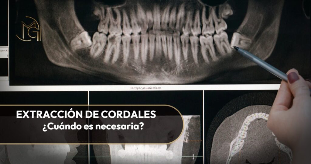 Cuándo es necesaria la extracción de cordales-Dra. Carolina Gil