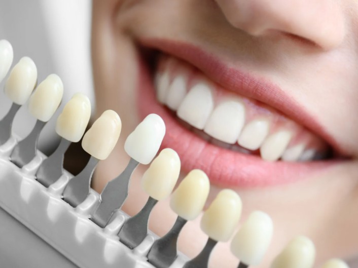 Blanqueamiento dental en la Clínica odontológica en Bogotá de la Dra. Carolina Gil