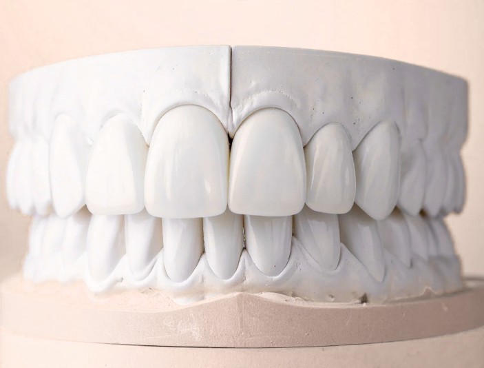 Carillas dentales en la Clínica odontológica en Bogotá de la Dra. Carolina Gil