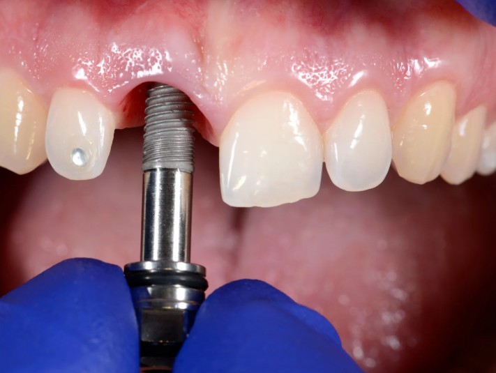 Cirugía de implantes dentales en la Clínica odontológica en Bogotá de la Dra. Carolina Gil