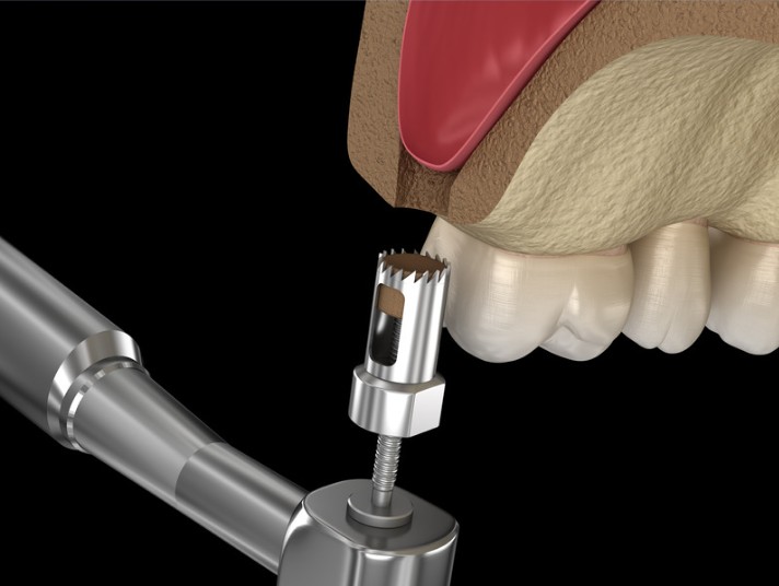 Elevación del seno maxilar en la Clínica odontológica en Bogotá de la Dra. Carolina Gil