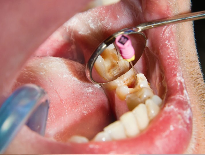 Endodoncia en la Clínica odontológica en Bogotá de la Dra. Carolina Gil