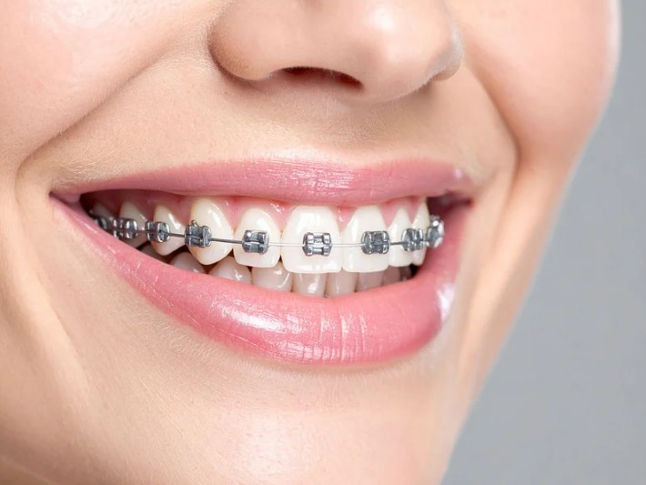 Ortodoncia en la Clínica odontológica en Bogotá de la Dra. Carolina Gil