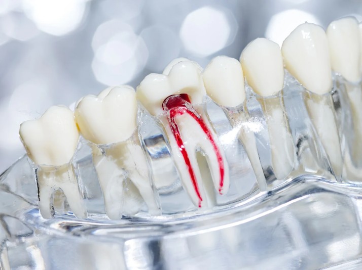 Tratamiento de conductos en la Clínica odontológica en Bogotá de la Dra. Carolina Gil