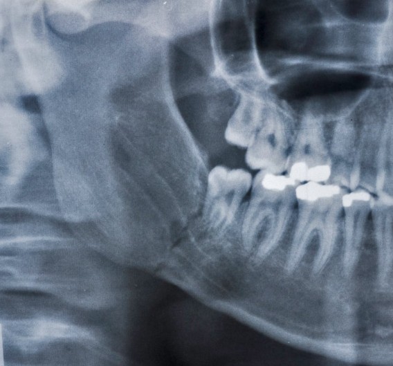 Hueso maxilar y mandibular - hueso dental - Dra. Carolina Gil odontóloga de Bogotá