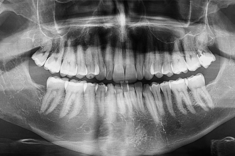 Injertos autólogos - Pérdida del hueso dental - Dra. Carolina Gil cirujana maxilofacial en Bogotá