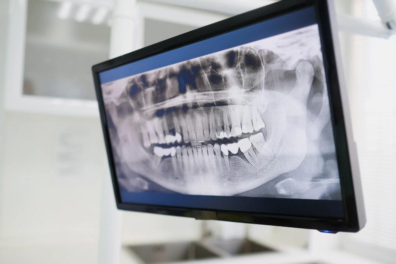 Injertos hetrólogos - Pérdida del hueso dental - Dra. Carolina Gil cirujana maxilofacial en Bogotá