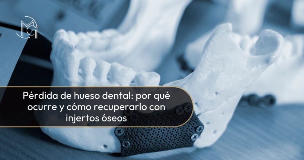 Pérdida del hueso dental - Dra. Carolina Gil cirujana maxilofacial en Bogotá