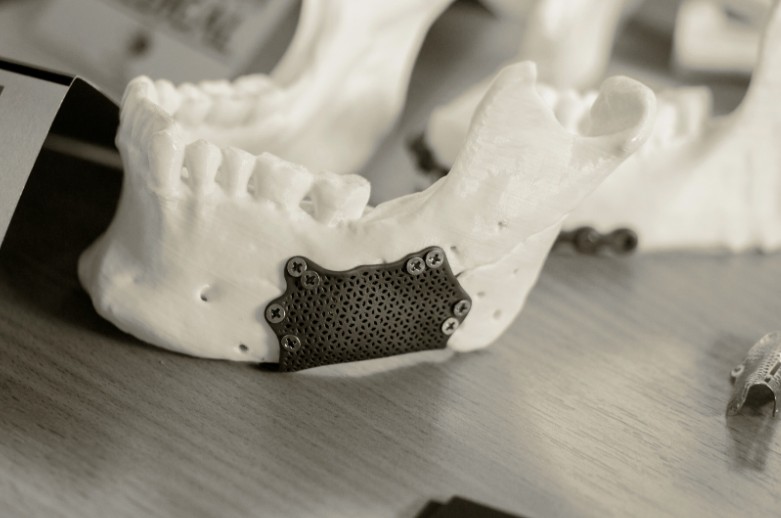 Tipo de injerto de hueso dental en Bogotá - Dra Carolina GIl