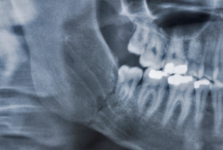 Tipo de injerto de oseo dental en Bogotá - Dra Carolina GIl