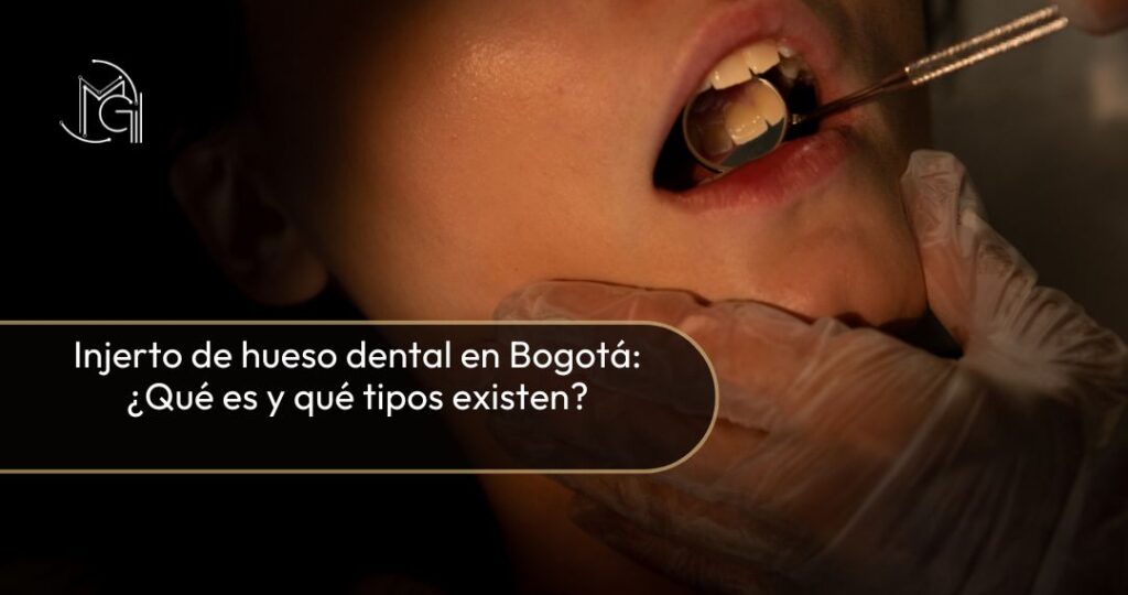 Tipos de injerto de hueso en Bogotá - Dra. Carolina Gil