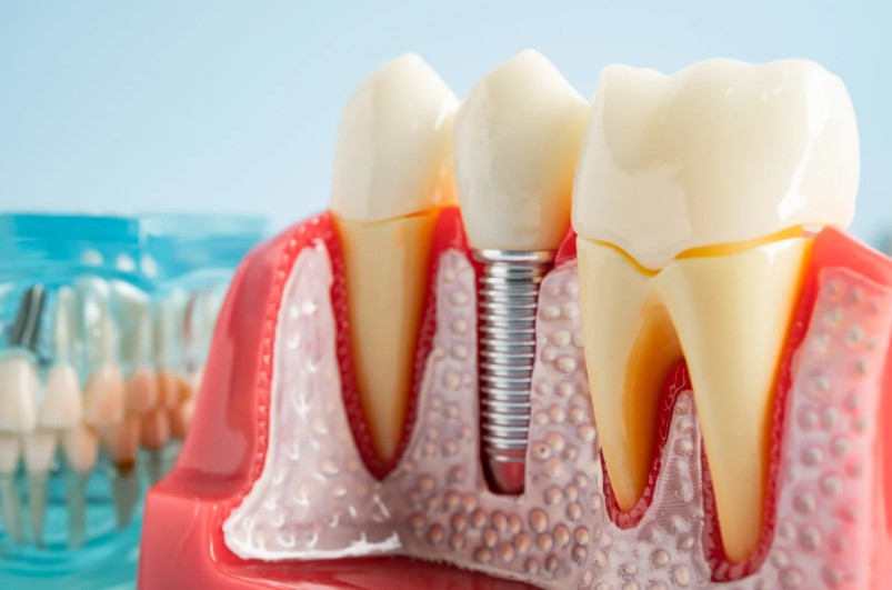 Beneficios implante dental de titaneo-Dra. Carolina Gil