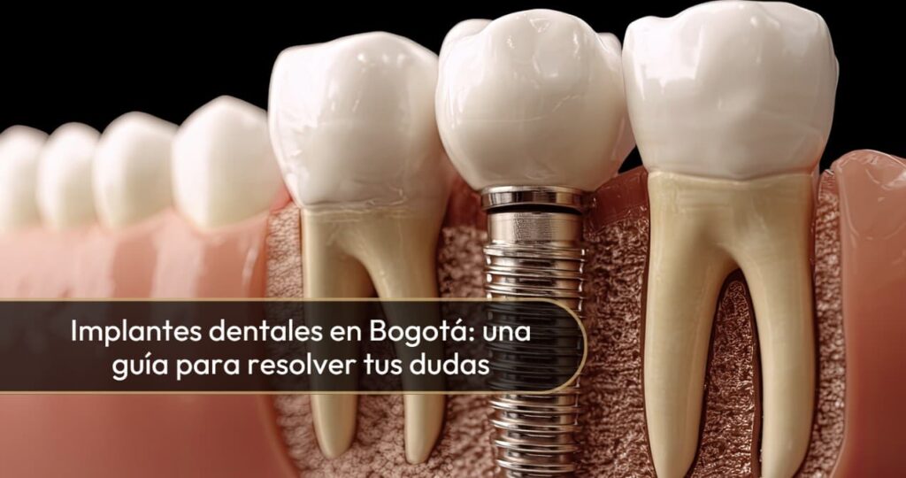 Implantes dentales en Bogotá-Dra. Carolina Gil