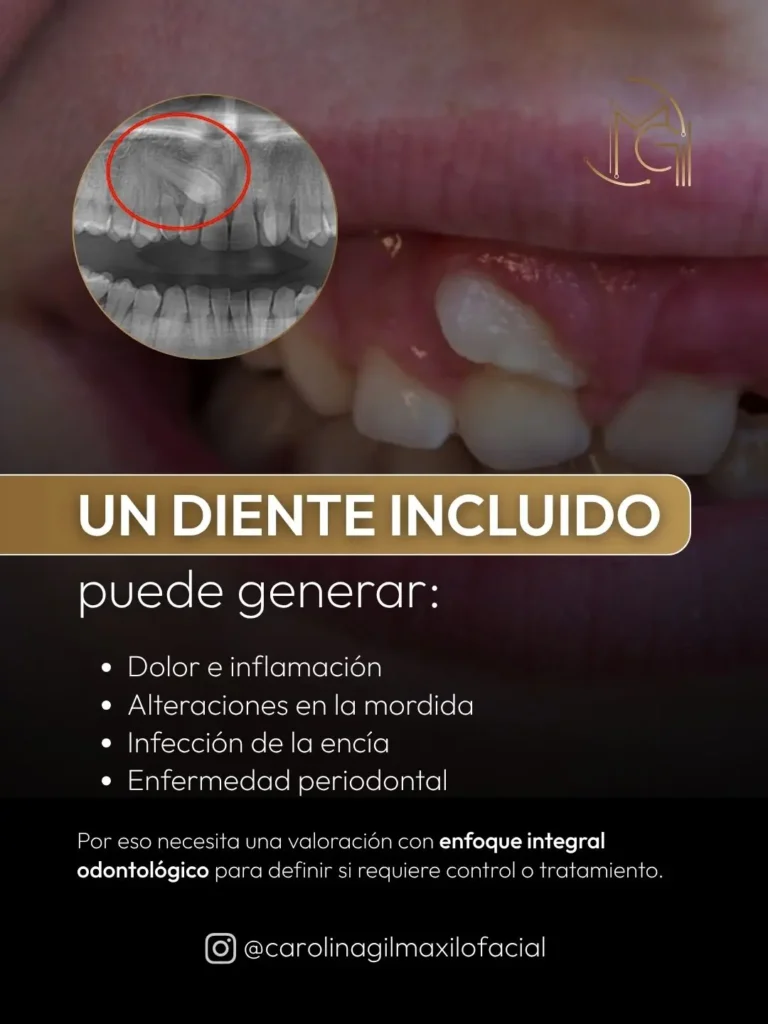 CAROLINA GIL - extraccion de diente retenido