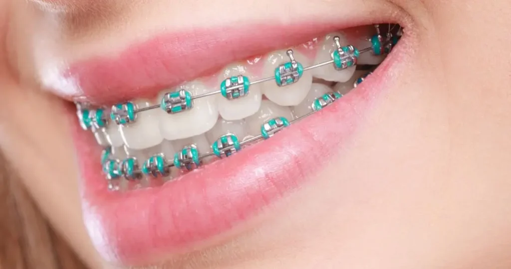 ORTODONCIA EN BOGOTÁ - DRA. CAROLINA GIL 2