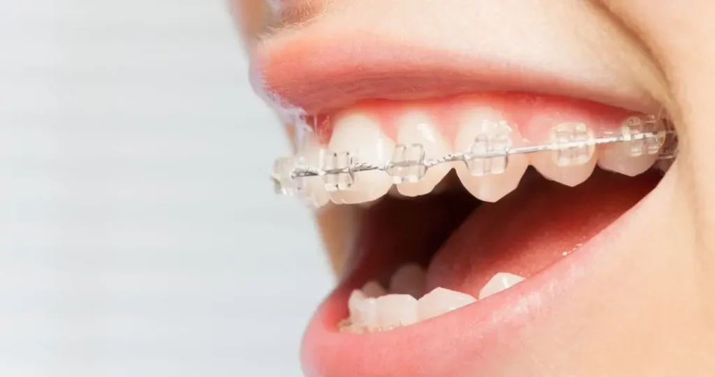 Ortodoncia con brackets cerámicos en Bogotá, Colombia - Dra. Carolina Gil cirujana oral y maxilofacial