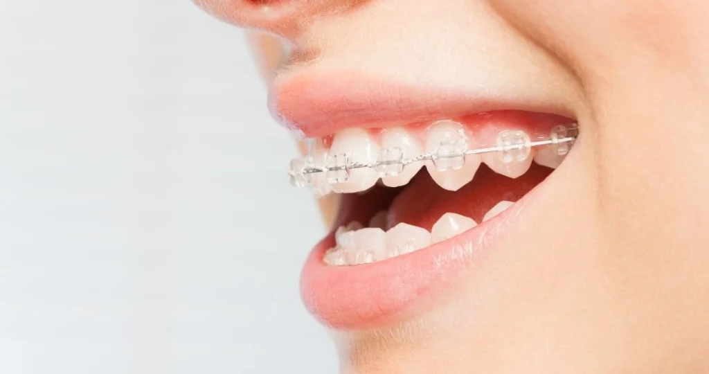 Brackets estéticos - Dr Carolina Gil