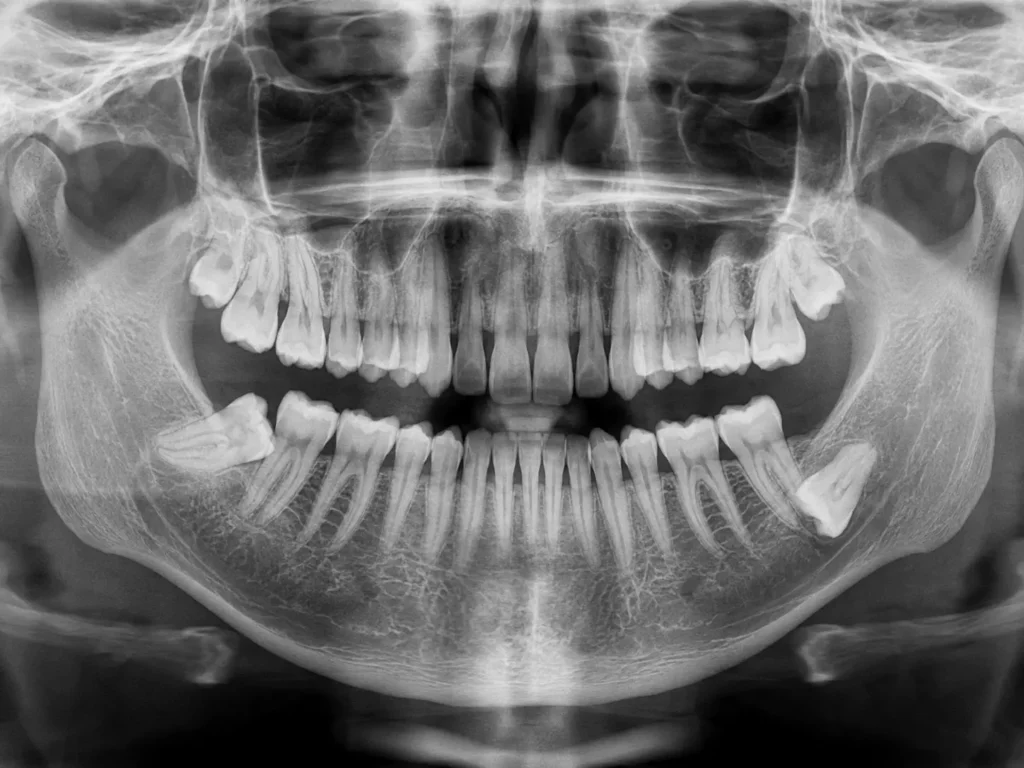 Radiografia dientes impactados - Dra Carolina Gil