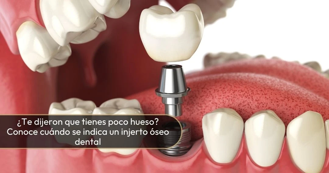 Te dijeron que tienes poco hueso Conoce cuándo se indica un injerto óseo dental - Dra Carolina Gil