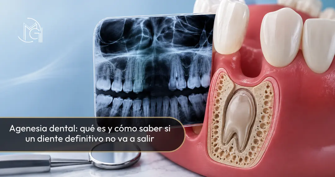 Agenesia dental - Dra. Carolina Gil - Bogotá, Colombia