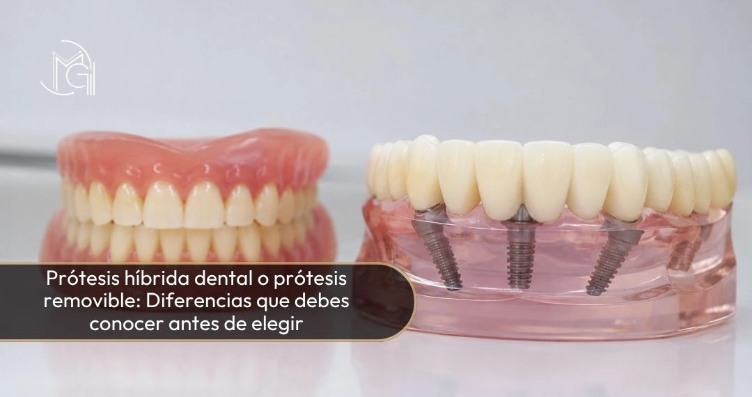 Prótesis híbrida dental o prótesis removible: Diferencias que debes conocer antes de elegir - Dra Carolina Gil - Bogotá