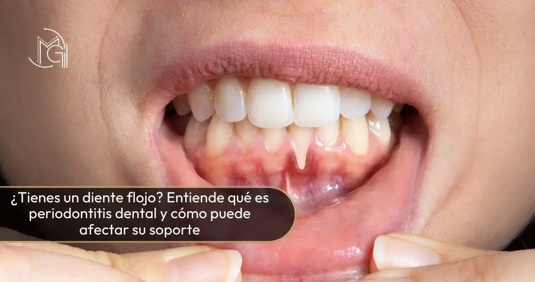 ¿Tienes un diente flojo Entiende qué es periodontitis dental y cómo puede afectar su soporte - Dra Carolina Gil